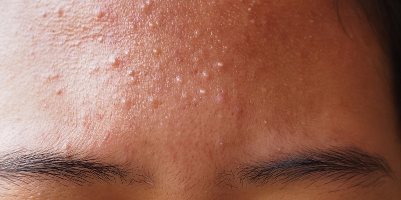 Forehead Acne Mapping - Diagnostic Guide for Hairline and T-Zone Breakouts