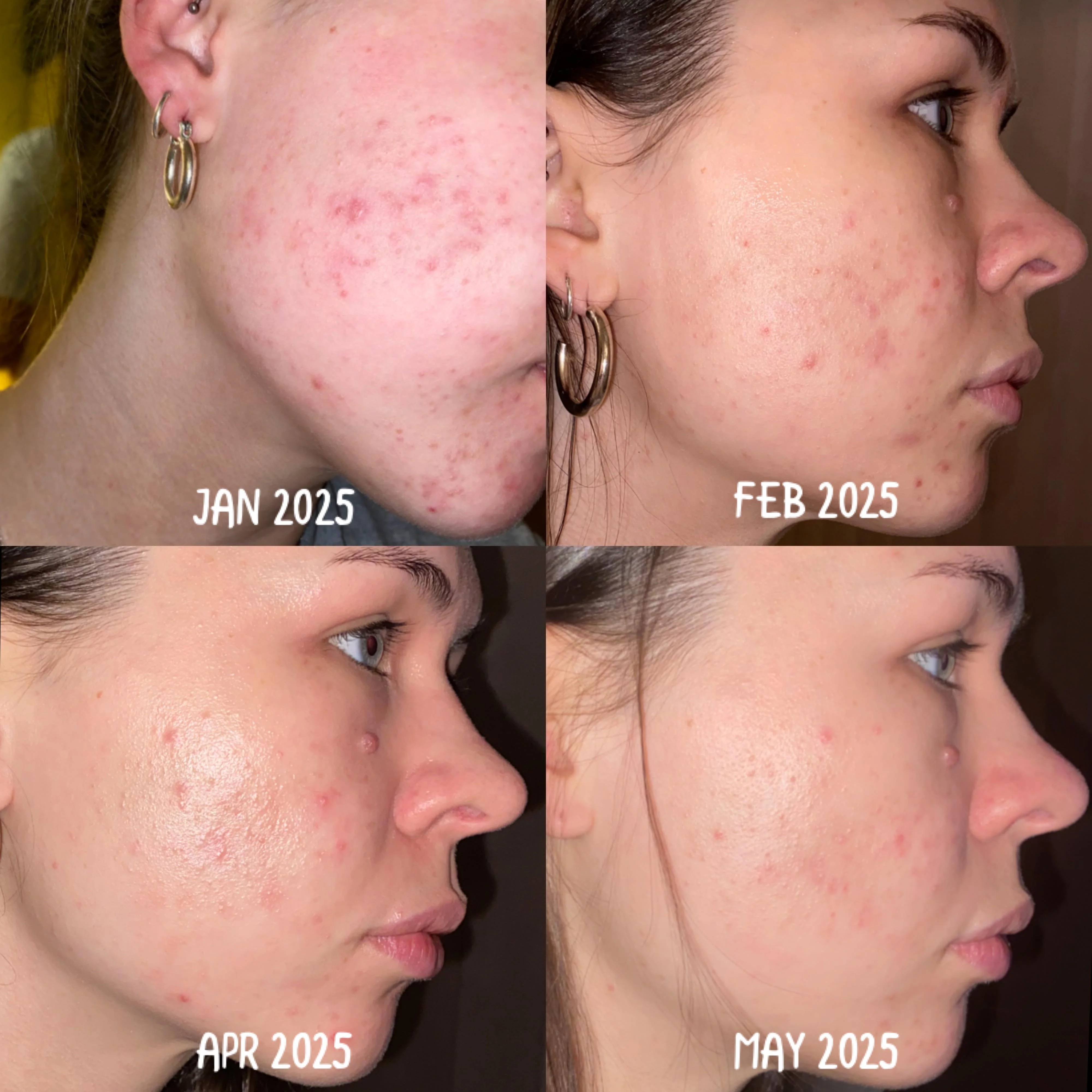 Real adapalene gel before and after results on acne prone skin