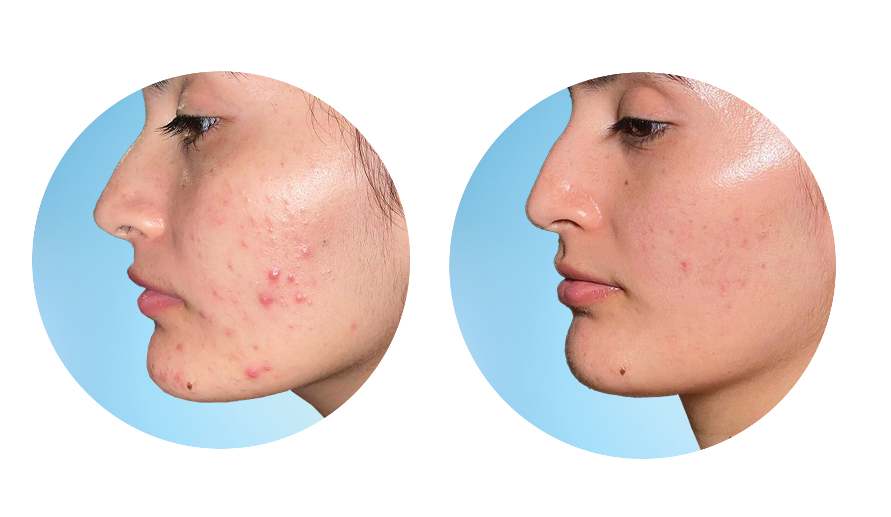 Adapalene and Clindamycin before and after clearing cystic acne