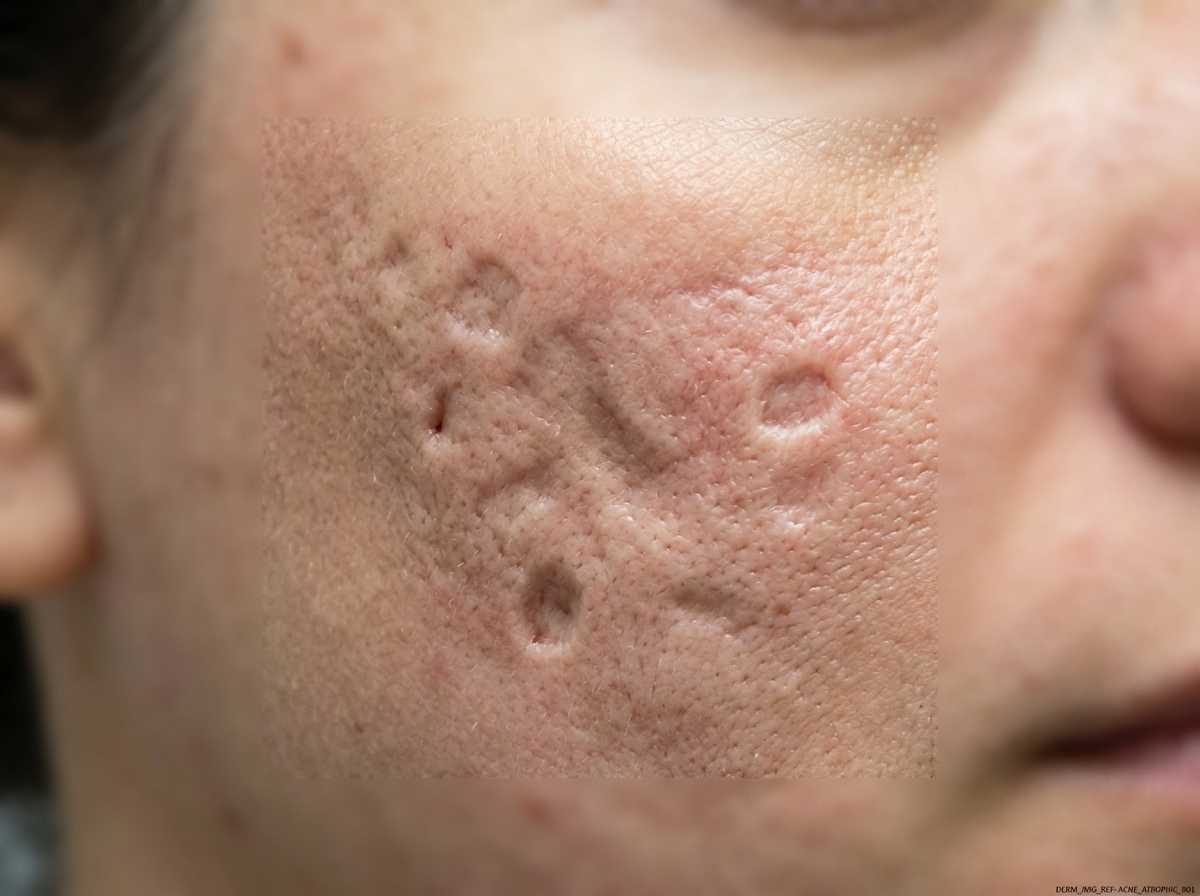 Close-up of atrophic acne scars (boxcar and rolling) on cheek skin showing texture